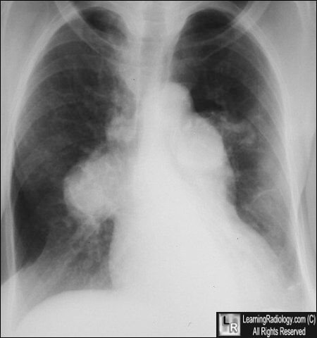 Pulmonary hypertension